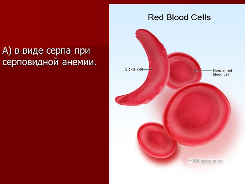 А) в виде серпа при серповидной анемии.
